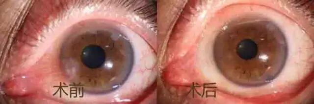 眼睛长 包块 当心胬肉