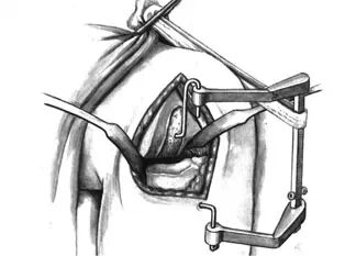 骨科用什么手术器械手术台如战场，骨科医生的十八般兵器盘点_https://www.jmylbn.com_新闻资讯_第5张