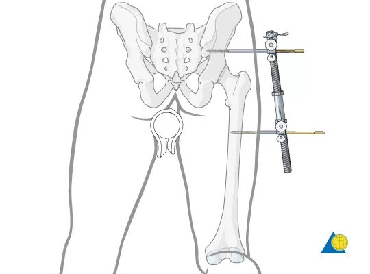 骨科用什么手术器械手术台如战场，骨科医生的十八般兵器盘点_https://www.jmylbn.com_新闻资讯_第4张
