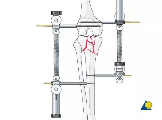 骨科用什么手术器械手术台如战场，骨科医生的十八般兵器盘点_https://www.jmylbn.com_新闻资讯_第3张