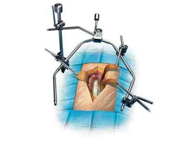 骨科用什么手术器械手术台如战场，骨科医生的十八般兵器盘点_https://www.jmylbn.com_新闻资讯_第7张