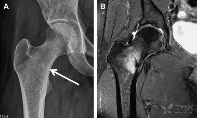 一例看不见骨折透亮线的骨折，新手估计会漏诊