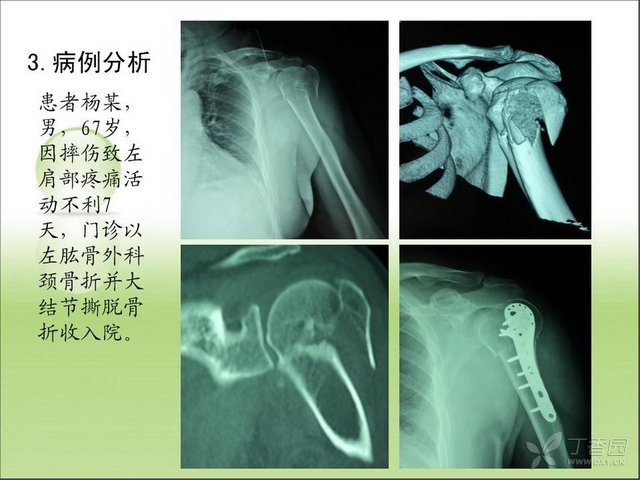 肱骨近端骨折分类及病例分析 - 小骨头 - 小骨头的博客