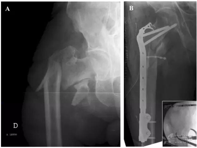 钢丝捆绑影响骨的血运吗？