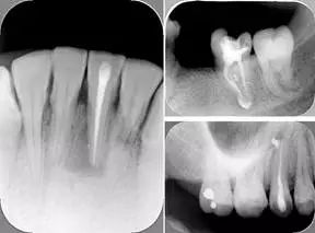 牙胶尖什么颜色​牙齿“晓”“技”｜最全根管治疗的标准步骤，以及细节把握_https://www.jmylbn.com_新闻资讯_第16张