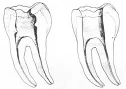 牙胶尖什么颜色​牙齿“晓”“技”｜最全根管治疗的标准步骤，以及细节把握_https://www.jmylbn.com_新闻资讯_第5张