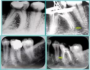 牙胶尖什么颜色【根管治疗】根管治疗的细节把握_https://www.jmylbn.com_新闻资讯_第27张