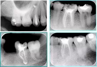 牙胶尖什么颜色【根管治疗】根管治疗的细节把握_https://www.jmylbn.com_新闻资讯_第17张