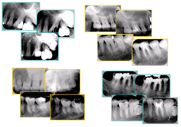 牙胶尖什么颜色​牙齿“晓”“技”｜最全根管治疗的标准步骤，以及细节把握_https://www.jmylbn.com_新闻资讯_第26张