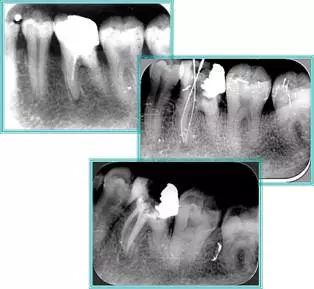 牙胶尖什么颜色​牙齿“晓”“技”｜最全根管治疗的标准步骤，以及细节把握_https://www.jmylbn.com_新闻资讯_第25张
