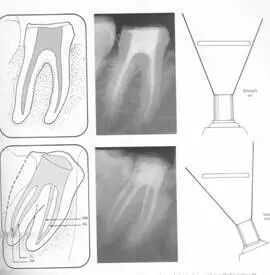 牙胶尖什么颜色​牙齿“晓”“技”｜最全根管治疗的标准步骤，以及细节把握_https://www.jmylbn.com_新闻资讯_第17张