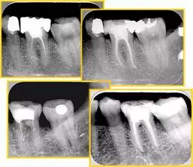 牙胶尖什么颜色【根管治疗】根管治疗的细节把握_https://www.jmylbn.com_新闻资讯_第22张
