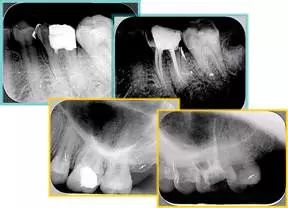 牙胶尖什么颜色​牙齿“晓”“技”｜最全根管治疗的标准步骤，以及细节把握_https://www.jmylbn.com_新闻资讯_第23张