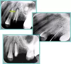 牙胶尖什么颜色​牙齿“晓”“技”｜最全根管治疗的标准步骤，以及细节把握_https://www.jmylbn.com_新闻资讯_第27张