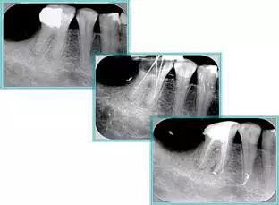 牙胶尖什么颜色【根管治疗】根管治疗的细节把握_https://www.jmylbn.com_新闻资讯_第28张