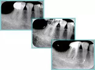 牙胶尖什么颜色​牙齿“晓”“技”｜最全根管治疗的标准步骤，以及细节把握_https://www.jmylbn.com_新闻资讯_第30张