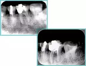 牙胶尖什么颜色​牙齿“晓”“技”｜最全根管治疗的标准步骤，以及细节把握_https://www.jmylbn.com_新闻资讯_第22张