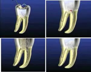 牙胶尖什么颜色​牙齿“晓”“技”｜最全根管治疗的标准步骤，以及细节把握_https://www.jmylbn.com_新闻资讯_第4张