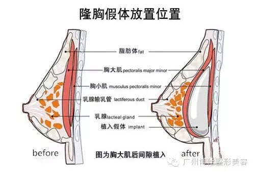 隆胸后会不会引发乳腺癌