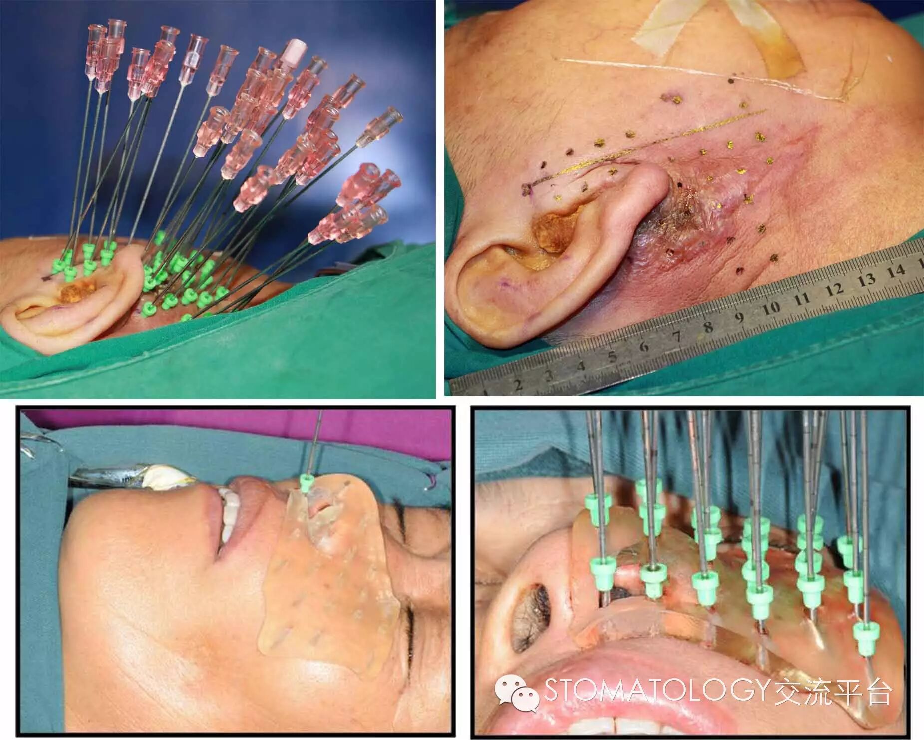 口腔颌面部恶性肿瘤放射性粒子植入治疗技术
