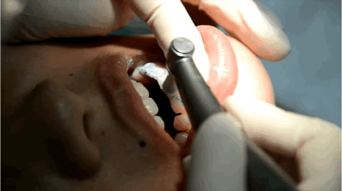 我们为了揭开洗牙的真相连鹌鹑蛋都不放过