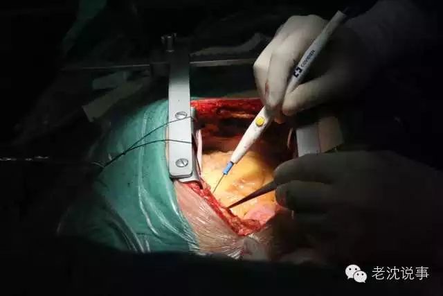 心脏搭桥手术全程,看完后请珍惜健康！（胆小慎入）