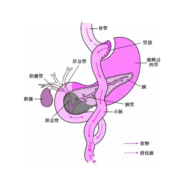 减肥手术多少钱_手术减肥_减肥手术哪种效果好