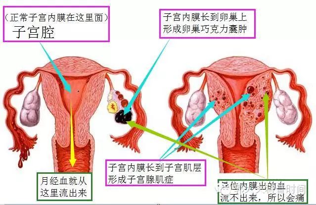 唯散宁是子宫腺肌病的克星吗 每日头条