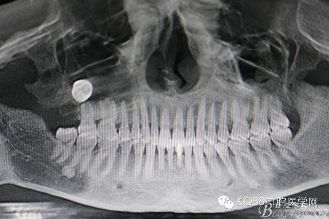 18颊舌向高位阻生,牙冠位于17牙根的正上方,怀疑18位于上颌窦内