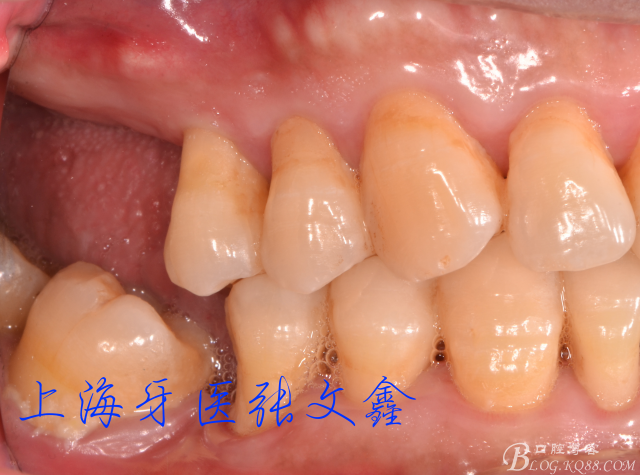 原创博客病例展示nobel上颌后牙游离缺失种植修复