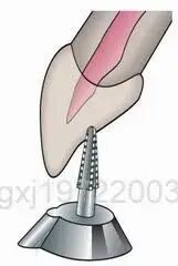 口腔H锉怎么消毒牙科医生必须看看----经典根管治疗总结_https://www.jmylbn.com_新闻资讯_第7张