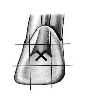 口腔H锉怎么消毒牙科医生必须看看----经典根管治疗总结_https://www.jmylbn.com_新闻资讯_第5张