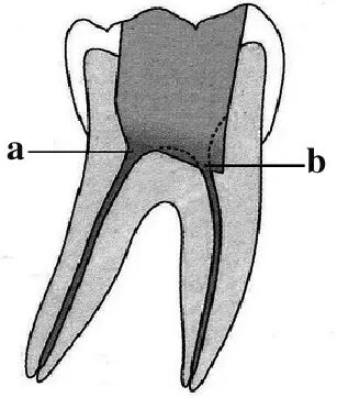 口腔H锉怎么消毒牙科医生必须看看----经典根管治疗总结_https://www.jmylbn.com_新闻资讯_第16张