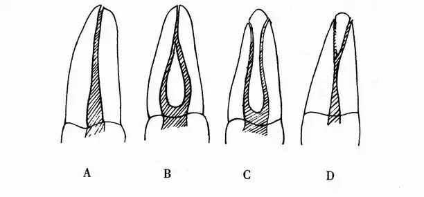 口腔H锉怎么消毒牙科医生必须看看----经典根管治疗总结_https://www.jmylbn.com_新闻资讯_第4张