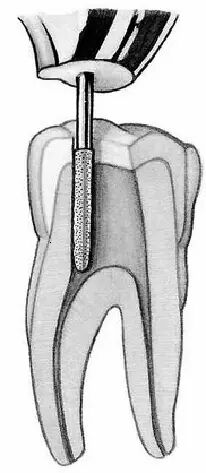 口腔H锉怎么消毒牙科医生必须看看----经典根管治疗总结_https://www.jmylbn.com_新闻资讯_第15张