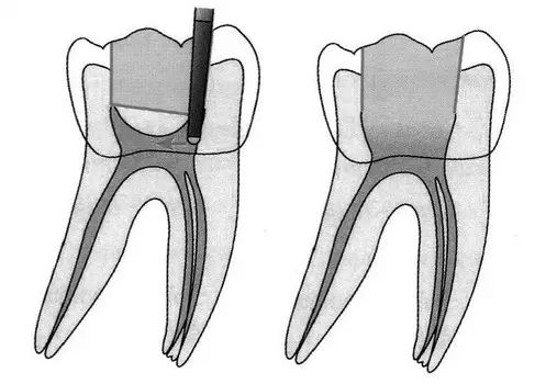 口腔H锉怎么消毒牙科医生必须看看----经典根管治疗总结_https://www.jmylbn.com_新闻资讯_第10张