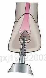 口腔H锉怎么消毒牙科医生必须看看----经典根管治疗总结_https://www.jmylbn.com_新闻资讯_第8张