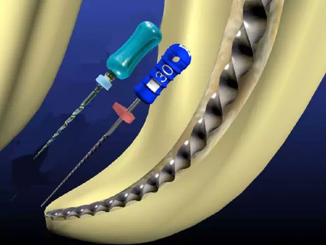 拔掉烂牙根多久才能补牙_烂牙根一般几年内必须拔_拔烂牙根有危险吗