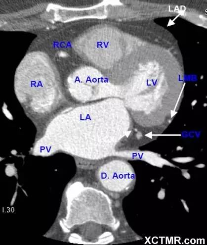 心脏ct解剖集锦下