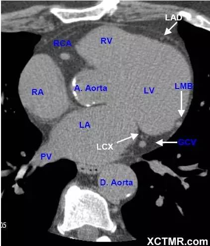 心脏ct解剖集锦下