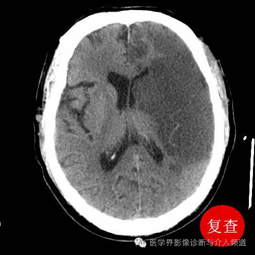 教你看懂超急性期腦梗塞ct徵象