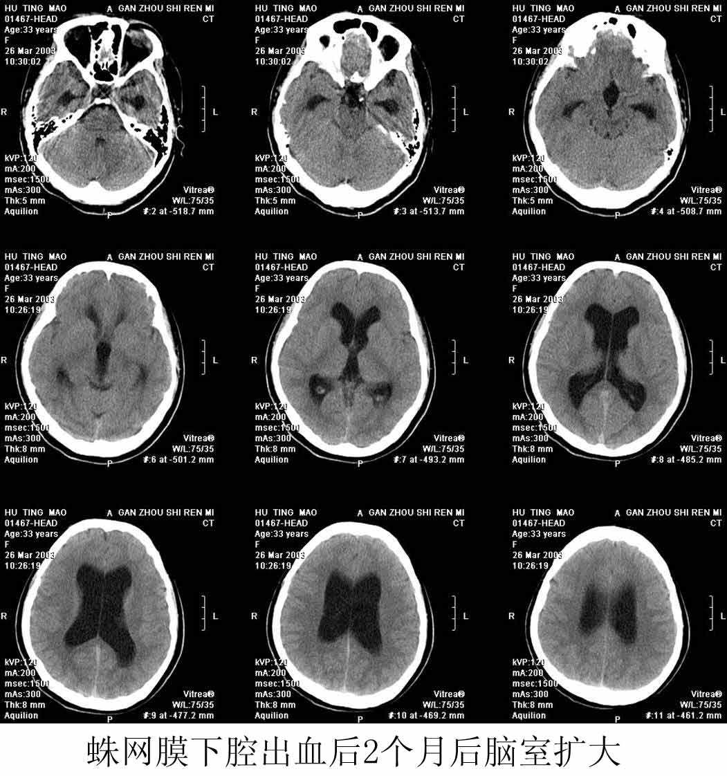 漫谈脑积水的ct诊断