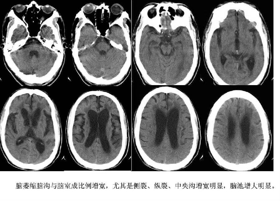 2,脑积水脑沟浅或消失,脑池不增大;脑萎缩脑沟与