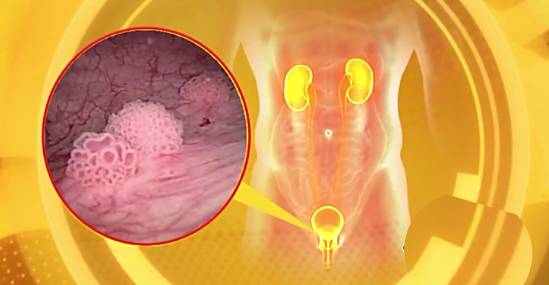 2"有痛"的血尿专家告诉我们,虽然"无痛"血尿是膀胱癌独特的标志,但有