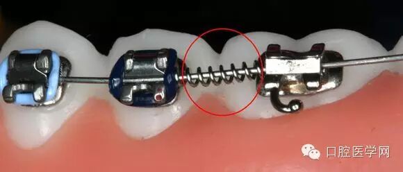 正畸颊面管是什么牙齿矫正科普帖：正畸牙套装置部件详解_https://www.jmylbn.com_新闻资讯_第45张