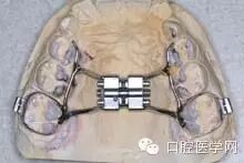 正畸颊面管是什么牙齿矫正科普帖：正畸牙套装置部件详解_https://www.jmylbn.com_新闻资讯_第26张
