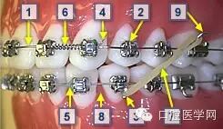 正畸颊面管是什么牙齿矫正科普帖：正畸牙套装置部件详解_https://www.jmylbn.com_新闻资讯_第51张