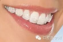 正畸颊面管是什么牙齿矫正科普帖：正畸牙套装置部件详解_https://www.jmylbn.com_新闻资讯_第10张