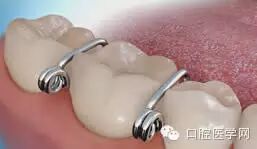 正畸颊面管是什么牙齿矫正科普帖：正畸牙套装置部件详解_https://www.jmylbn.com_新闻资讯_第39张