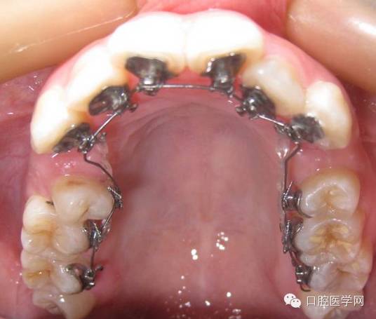正畸颊面管是什么牙齿矫正科普帖：正畸牙套装置部件详解_https://www.jmylbn.com_新闻资讯_第13张
